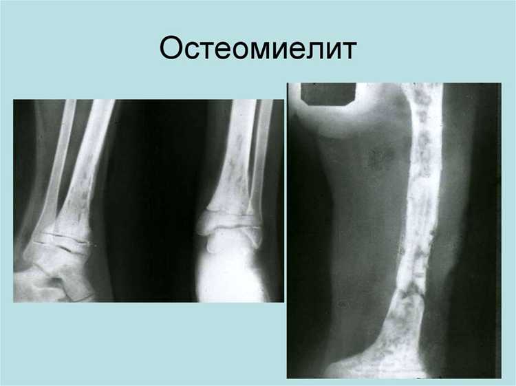 Различия между остеомиелитом и другими заболеваниями костей