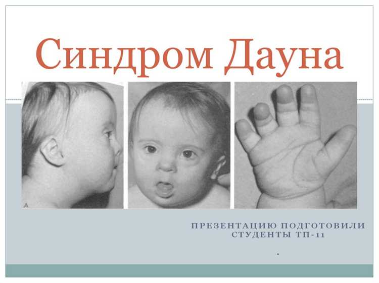 Наследственность и ее связь с синдромом Дауна