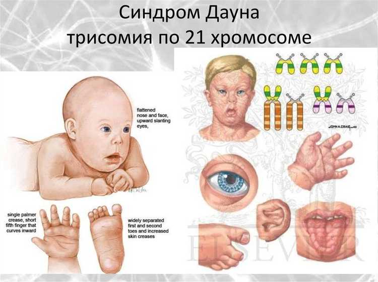 Социальная интеграция людей с синдромом Дауна