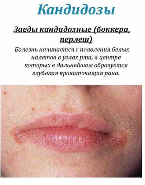 Симптомы и признаки заед